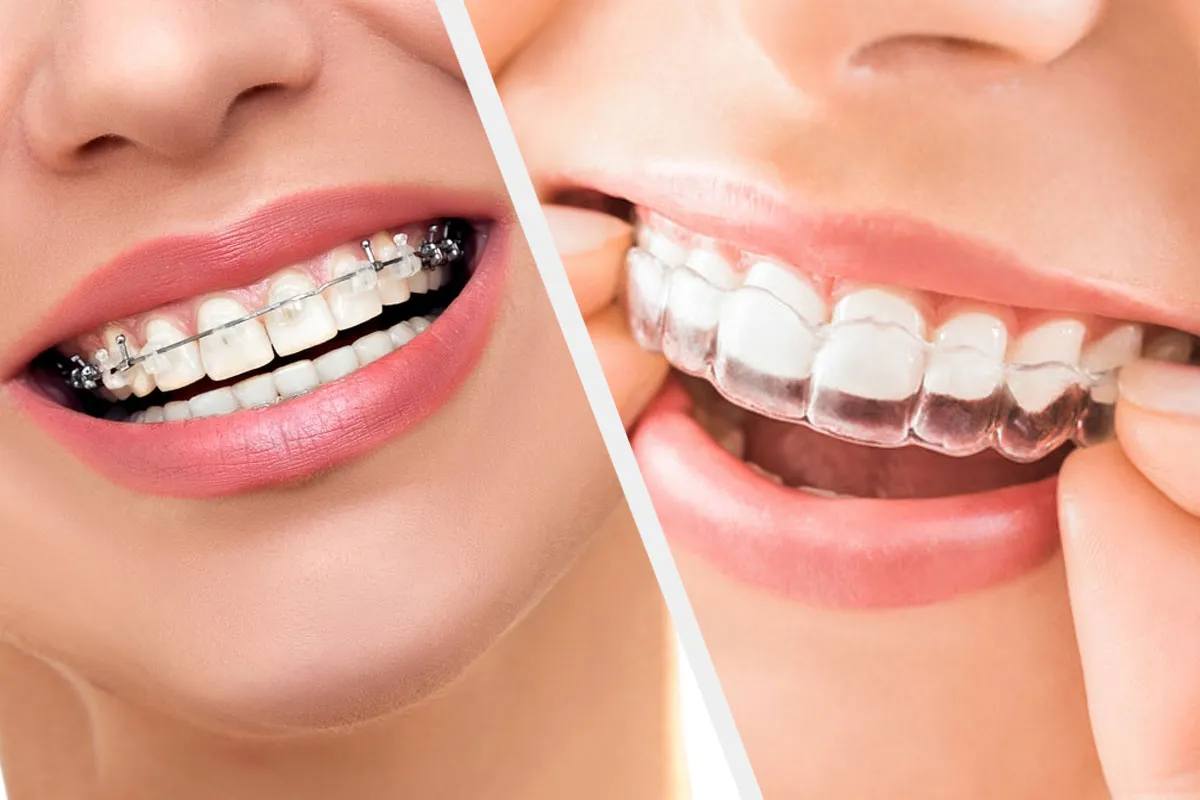 Best Orthodontist in RR Nagar