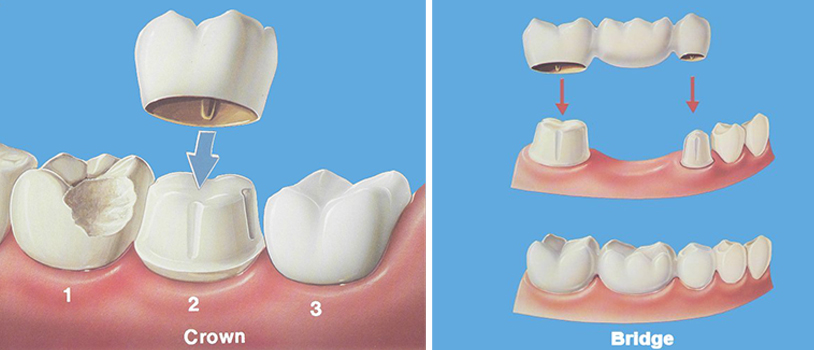 Crowns and Bridges Dental Treatment in RR Nagar