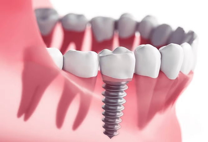 Best Dental Implant Clinic in RR Nagar