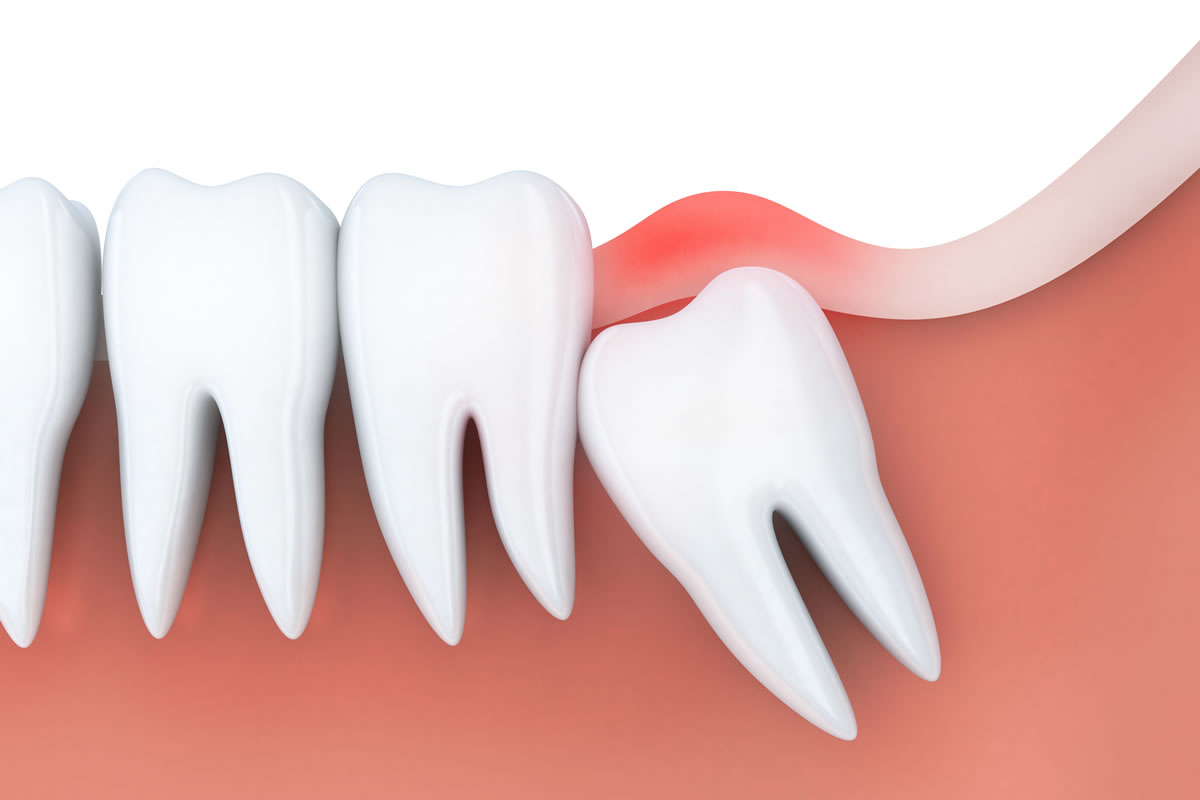 Wisdom Tooth Removal Treatment in RR Nagar